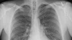 Šokantne fotografije pluća pacijenata: I jedan i drugi su bolovali od covida! Jedan je cijepljen, drugi ne!